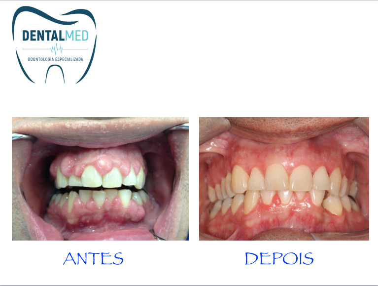 Hiperplasia gengival - site Dental Mend Odontologia